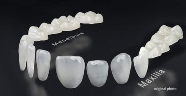 EDELWEISS LASER SINTERED VENEERS