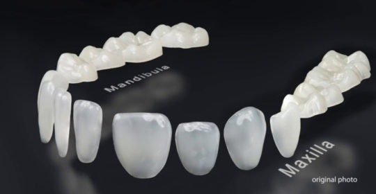 EDELWEISS LASER SINTERED VENEERS