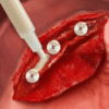 Putty – Bild 5